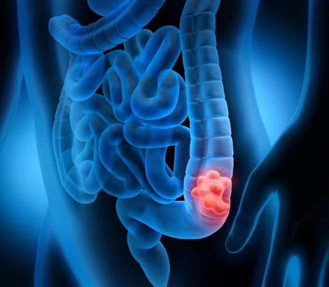 Câncer de intestino está entre os mais comuns para homens e mulheres